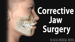 Corrective Jaw Orthognathic Surgery Animation [upl. by Flemming]