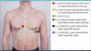 ¿CÓMO Y DÓNDE COLOCAR LOS ELECTRODOS PRECORDIALES [upl. by Mmada]