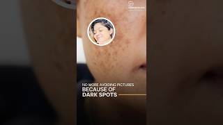 Have you tried Kojic acid ever I think it’s a best ingredient for dark spot darkspottreatment [upl. by Fernando384]