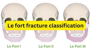 Le fort fracture classification [upl. by Ananna]