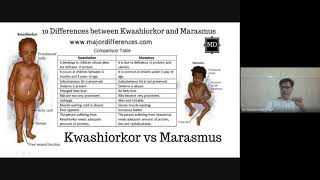 Kwashiorkor and Marasmus What’s the Difference [upl. by Eelta]