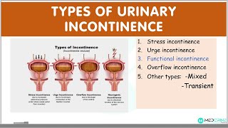 Types of Urinary Incontinence EXPLAINED Stress urge functional overflow incontinence [upl. by Botsford]