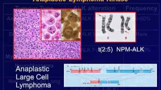 GRACEcast084LungCancerALK Inhibition Science and Early Clinical Experience by Dr Ben Solomon [upl. by Neslund]