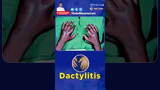 Understanding Dactylitis  Rheumatology amp Arthritis Doctor in Hyderabad  Dr Dheeraj Kondagari [upl. by Wittenburg]