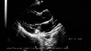 mitral valve prolapse and mitral annular calcification [upl. by Dex249]