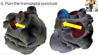 Imaging of Left atrial appendage closureexclusion [upl. by Gentille662]