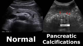 Pancreas Ultrasound Normal Vs Abnormal Appearances Comparison Pancreas Pathologies On Ultrasound [upl. by Kulda]