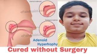 Enlarged Adenoids Hypertrophy Treated without Surgery Operation। Home Remedies । Naturopathy। ENT [upl. by Ssew]