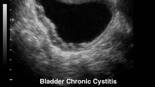 Ultrasound video showing cystitis cystitis medical ultrasound usg shorts viral trending medi [upl. by Anelem]