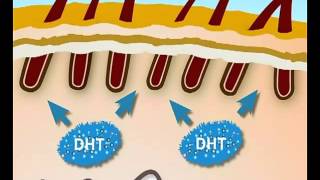 ¿QUE ES LA ALOPECIA ANDROGENETICA [upl. by Norword13]