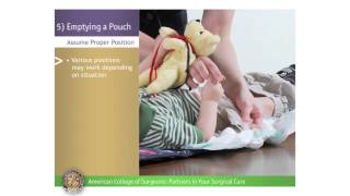 Pediatric Urostomy Emptying a Pouch [upl. by Adirahs]