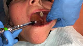 Inferior Alveolar and Lingual Nerve Blocks [upl. by Odlaw]