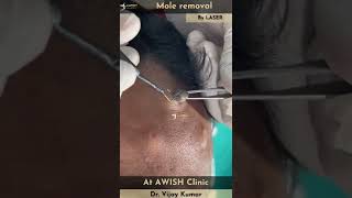 Mole on forehead Removal by RF  Painless mole removing mole remove moles awishclinic shorts [upl. by Ajet]