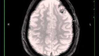 Meningioma left frontal [upl. by Elay]