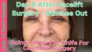 8 Days After Facelift Surgery  Stitches Out 11 [upl. by Changaris507]