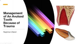 Management of an Avulsed Tooth [upl. by Adnohsirk30]