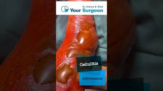 Cellulitis  Complete Information  What is Cellulitis  Treatment Options  Reasons  Debridement [upl. by Desimone]