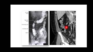 Ileocecal valve [upl. by Ahsaenat]