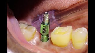 Implant Fixture Level Impression  Open Tray Impression Technique For Implants  Stepwise Procedure [upl. by Odlamur]