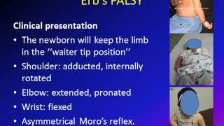 Obstetric Brachial Plexus Palsy OBPP Erbs Palsy [upl. by Hartzke]