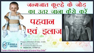 Congenital Hip Dislocation जन्मजात कूल्हे के जोड़ का उतर जाना पहचान एवं इलाज Dr J K Jain [upl. by Akemrehs506]