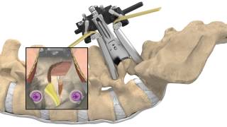 MAS® TLIF Patient Animation [upl. by Iives]