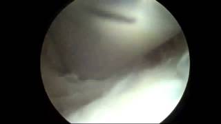 Endoscopic Olecranon Bursa Excision at Elbow by Houston TX Orthopedic Surgeon Dr Jeffrey E Budoff [upl. by Alioz458]