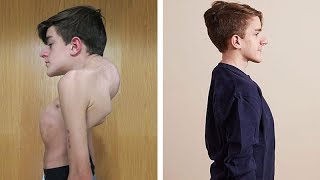 John Sarconas Testimonial  Overcoming Severe Scoliosis and Kyphosis [upl. by Leiser]