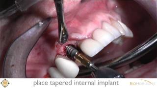 Single Tooth Replacement Using Tapered Internal with LaserLok [upl. by Ariadne]