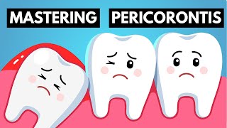 From Identifying To Management  Become An Expert On Pericoronitis [upl. by Nileuqaj751]