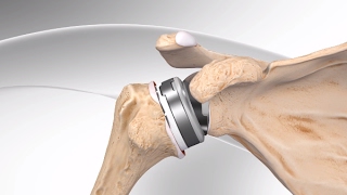 Reverse Total Shoulder Replacement with Univers Revers™ System [upl. by Radley]