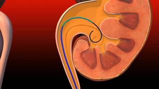 Ureteral Obstruction  Retrograde insertion of Resonance stent [upl. by Nauqan]