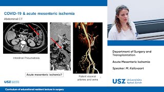 Acute Mesenteric Ischemia – Please participate in our 3minute survey below [upl. by Neersin407]