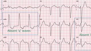 How to identify Left Bundle Branch Block in an ECG [upl. by Pammy821]