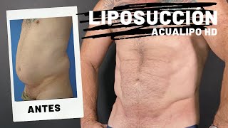 LIPOSUCCIÓN ABDOMEN Y FLANCOS EN HOMBRE MADURO CON DEFINICIÓN [upl. by Faubert807]