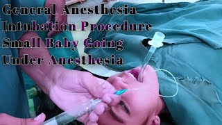 General Anesthesia Intubation Procedure  Small Baby Going Under Anesthesia  Anesthetic Waseem [upl. by Oretos]