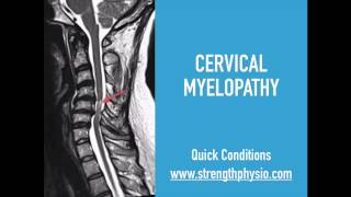 Cervical Spine Myelopathy [upl. by Phares]