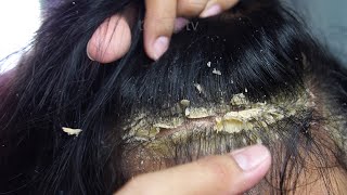 Dandruff scratching removal on head using black combing79 [upl. by Egduj4]