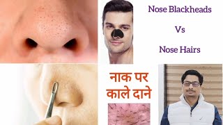 Trichostasis Spinulosa  Nose Blackheads  Nose Hairs  Nose Acne नाक पर काले दाने और बाल nosehair [upl. by Witcher58]