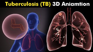 What Happens in Tuberculosis TB  3D Animation  Types Causes Symptoms Treatment UrduHindi [upl. by Avika]