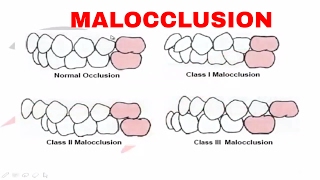 Malocclusion  Part I [upl. by Mehetabel]