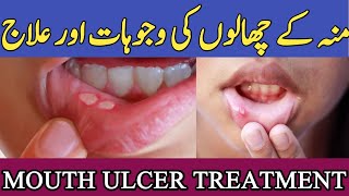 munh ke chalon ka ilajmouth ulcer treatmentmouth ulcer home remedieshealthsecrets [upl. by Esirahc503]