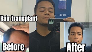 Hair transplant time lapse  Hair transplant before and after [upl. by Whetstone847]