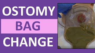 Ostomy Bag Pouch Change  Ostomy Care Nursing  Colostomy Ileostomy Bag Change [upl. by Aicaca]