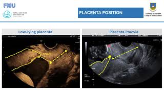 Basic Obstetrics Ultrasound  Dr Cladious Verenga [upl. by Eimme]