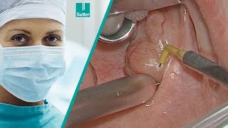 Radiofrequency Tonsillotomy using ARROWtip™  Jochen Windfuhr MD [upl. by Milzie]