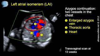 Left atrial isomerism with congenital heart block [upl. by Deloris236]