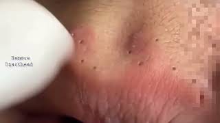 Acne on Forehead  Blackhead Removal on his forehead  Acne Treatment removeblackhead [upl. by Ellemac]