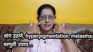 वांग उठणेhyperpigmentation home remedy tipsmelasmaskin care part 5 [upl. by Zednanref471]