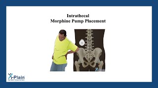 Intrathecal Morphine Pump Placement [upl. by Allecnirp611]